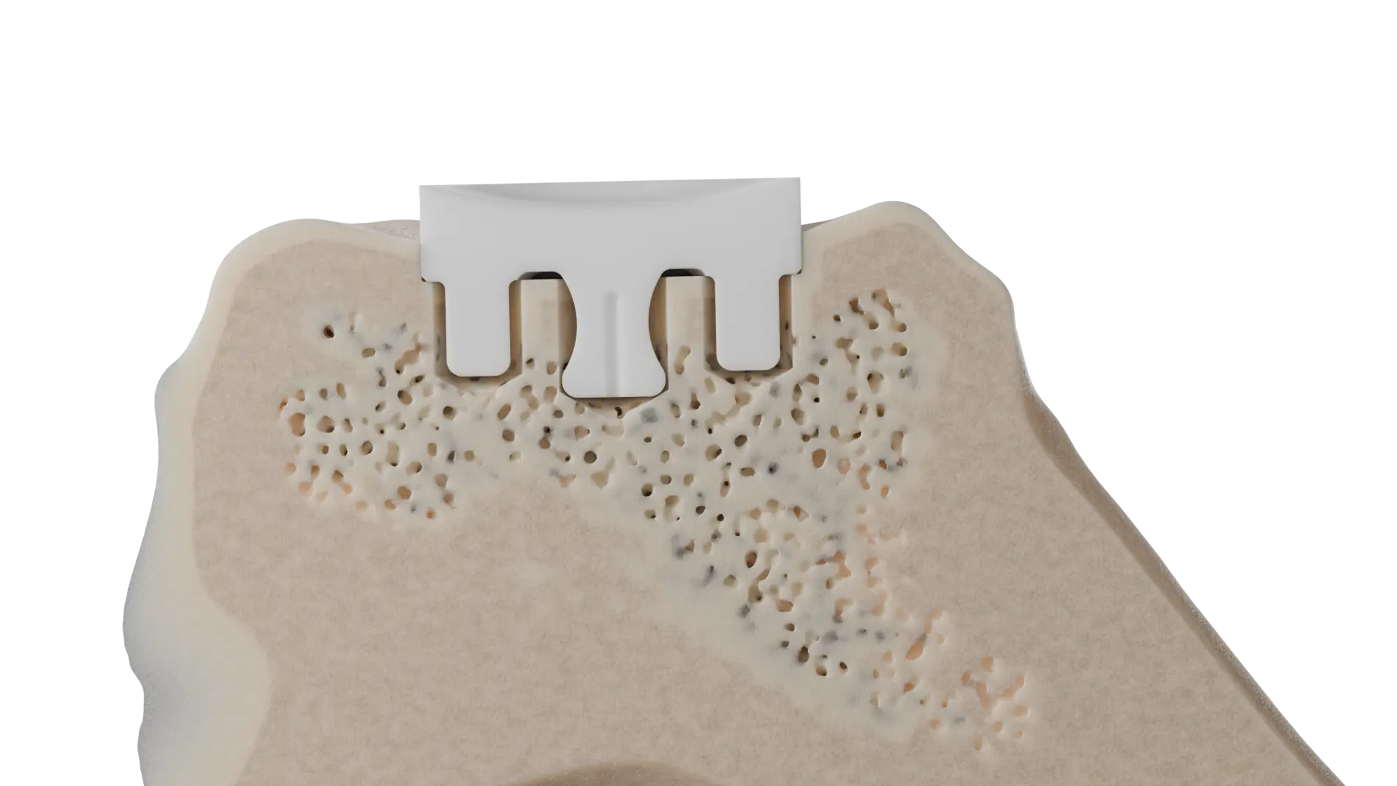 InSet® glenoid implant seated within the glenoid bone