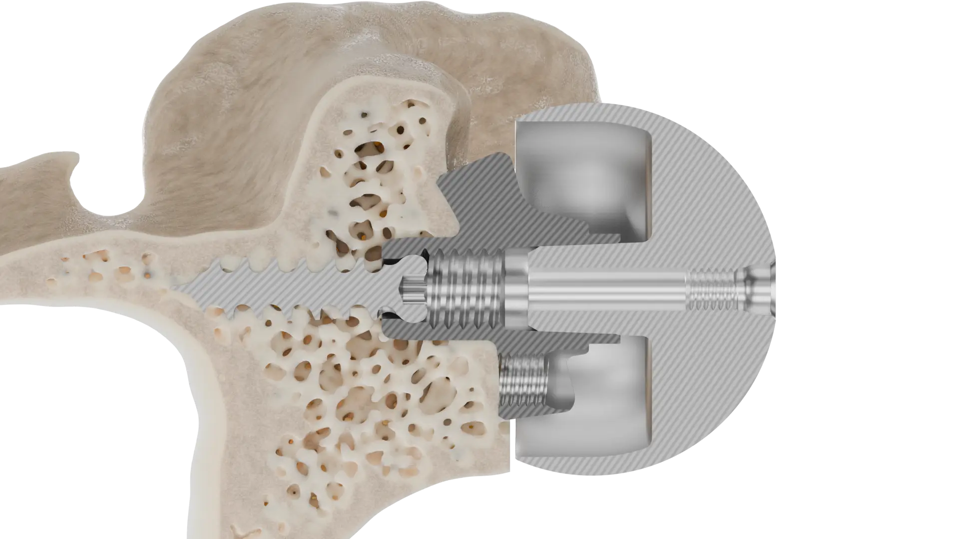 InSet® reverse baseplate seated within the glenoid bone