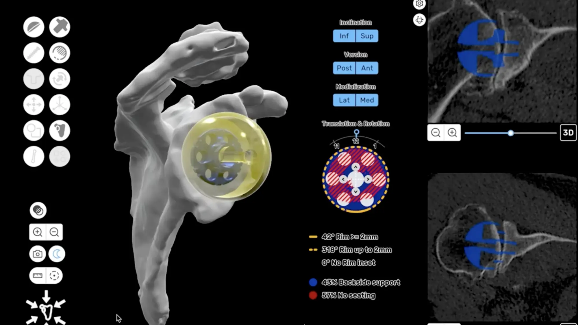 CT-based 3D preoperative plan for a reverse shoulder replacement
