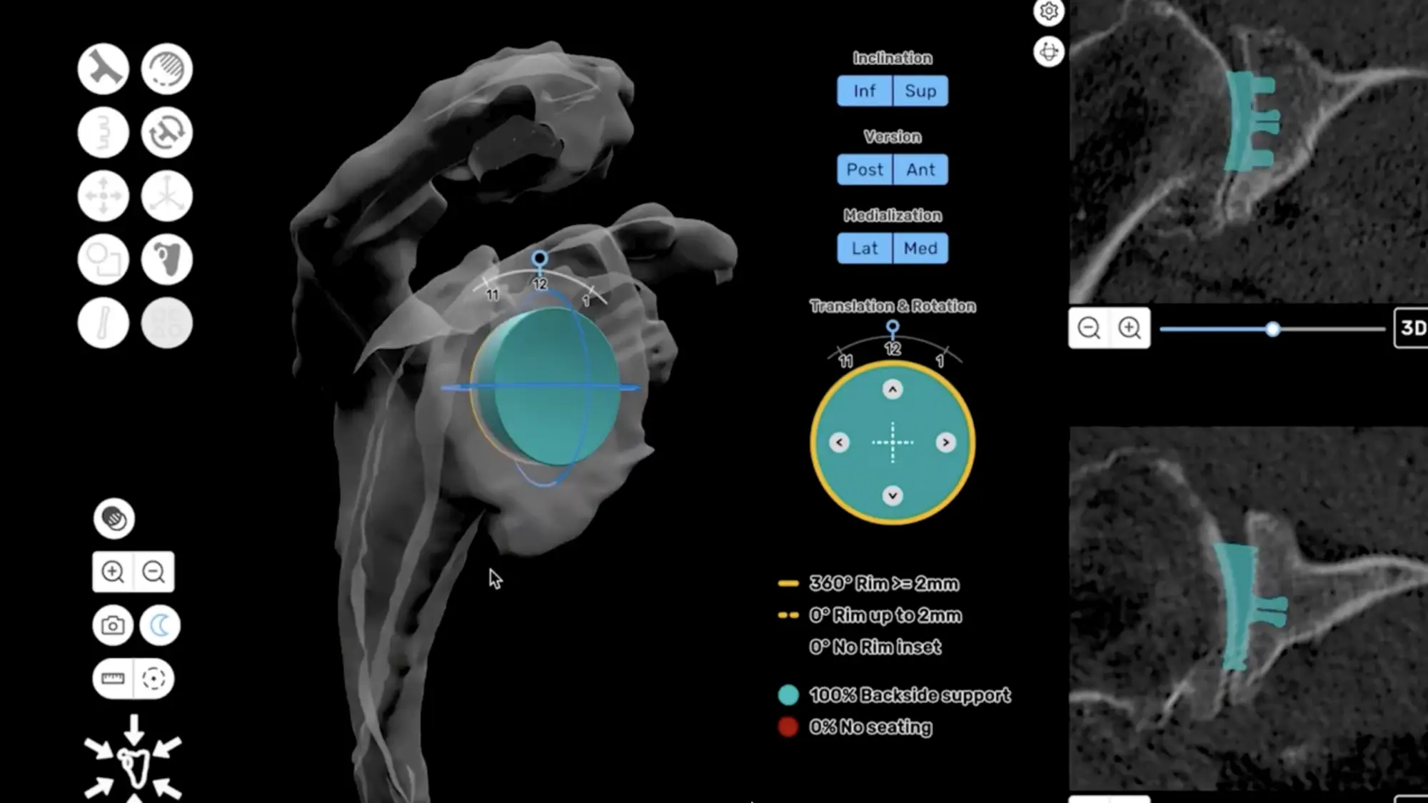 CT-based 3D preoperative plan for a total shoulder replacement