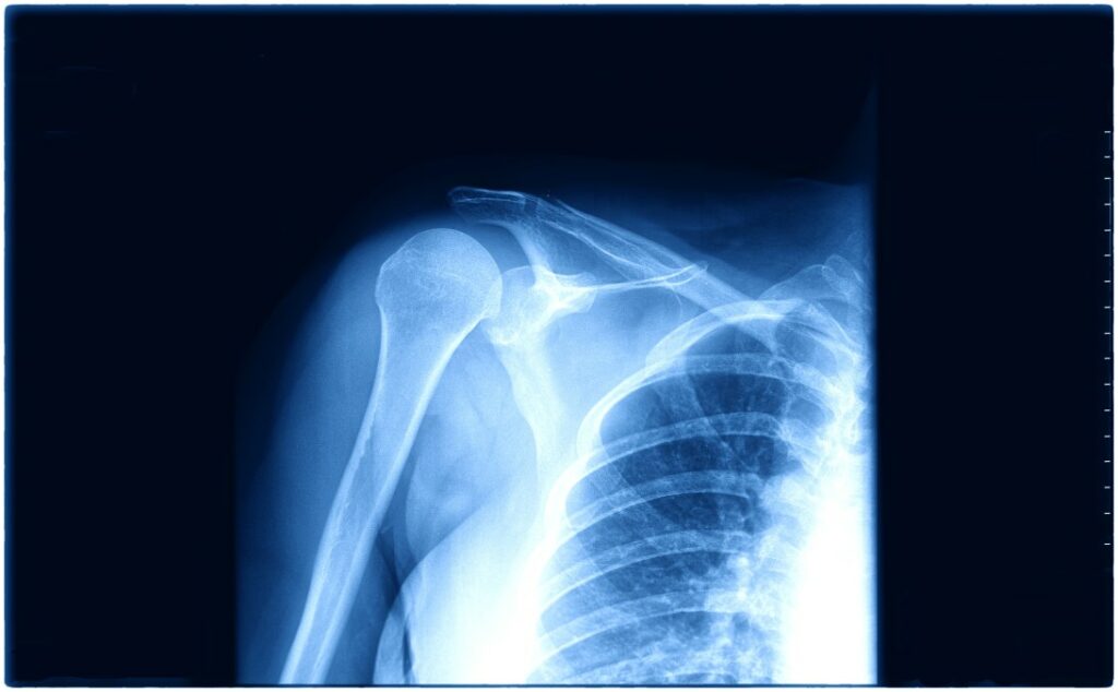 most common types of shoulder surgeries - x-ray of a shoulder